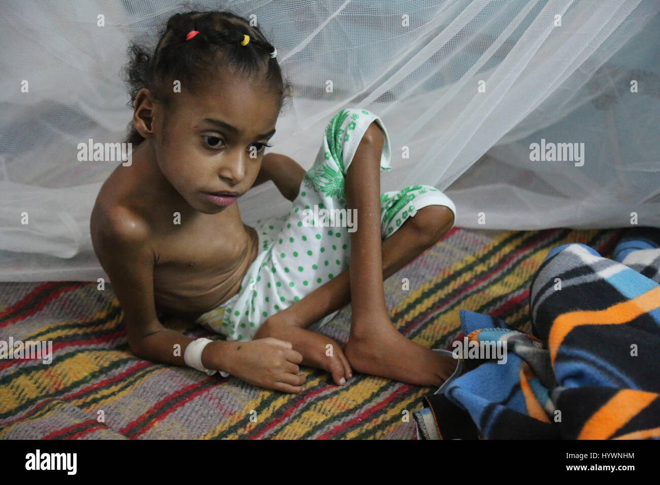 25. April 2017 - sind jemenitische Kinder in Jemens südwestlichen Stadt Taiz einer extrem schwierigen gesundheitlichen Bedingungen aufgrund des Mangels an funktionierende Krankenhäuser und Mangel an Medikamenten ausgesetzt. Eines der wenigen funktionierenden Krankenhäuser in Taiz ist das schwedische Krankenhaus. Ein großer Teil der Kinder in der Stadt sind stark unterernährt, während viele Artillerie-Beschuss und Bombardierung durch die Huthi-Rebellen und Ali Abdullah Salihs Kräften ausgesetzt sind. UNICEF und World Food Program (WFP) haben davor gewarnt, dass eine halbe million jemenitische Kinder in Gefahr des Todes, nach der Verschlechterung der Lage in der Stockfoto
