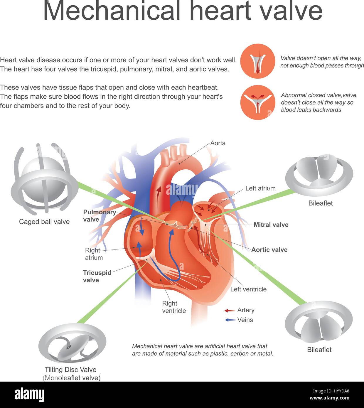 Mechanisches Herz sind künstliche Ventil, die aus Materialien wie Kunststoff, Carbon oder Metall bestehen Stock Vektor