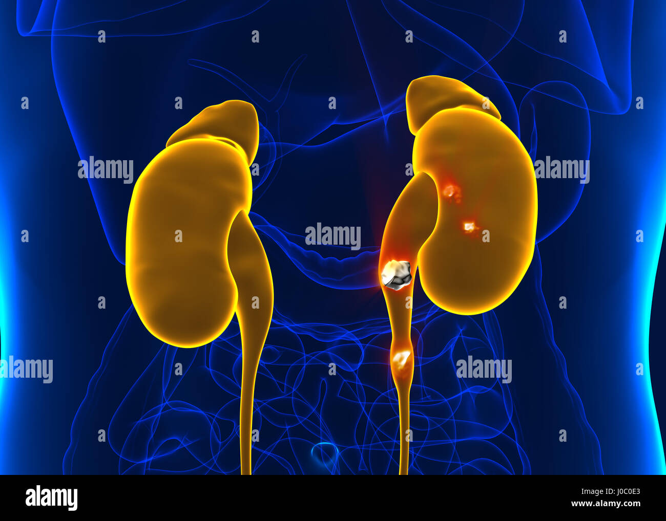 Nierensteine Anatomie Schmerz männliche interne Organ schmerzhaft kristallklarem mineralischen Querschnitt - 3d illustration Stockfoto