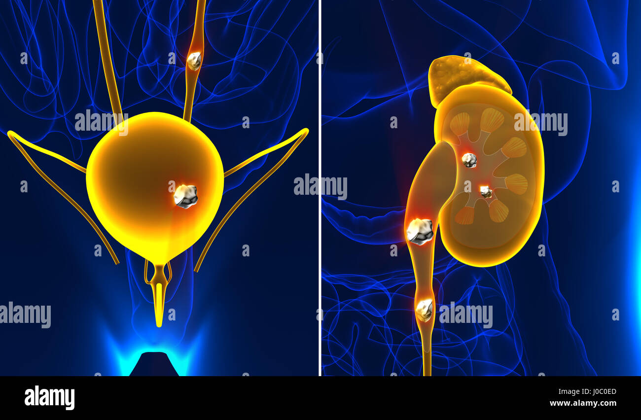 Nieren- und Harnsteine Anatomie Schmerz männliche interne Organ schmerzhaft kristallklarem mineralischen Querschnitt - 3d illustration Stockfoto