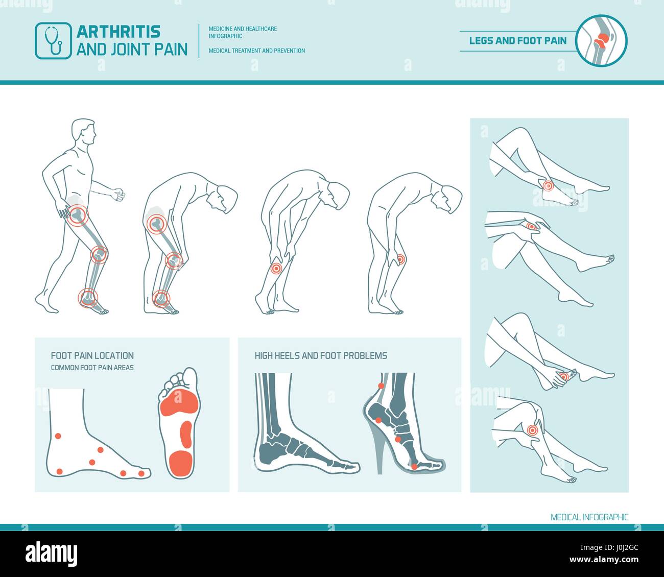 Fußschmerzen, Bein Schmerzen und Arthritis Infografik: Entzündung Spots, Schmerzregionen und Highheels Schaden Stock Vektor