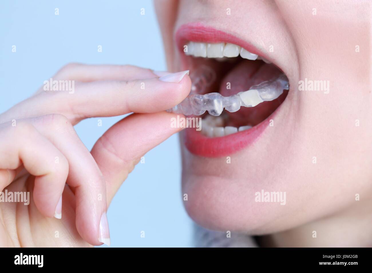 Eine zahnärztliche Zahnschiene bewachen für Zähne Stockfoto