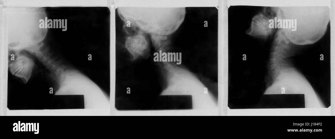 Röntgenbild der menschliche Halswirbelsäule Stockfoto