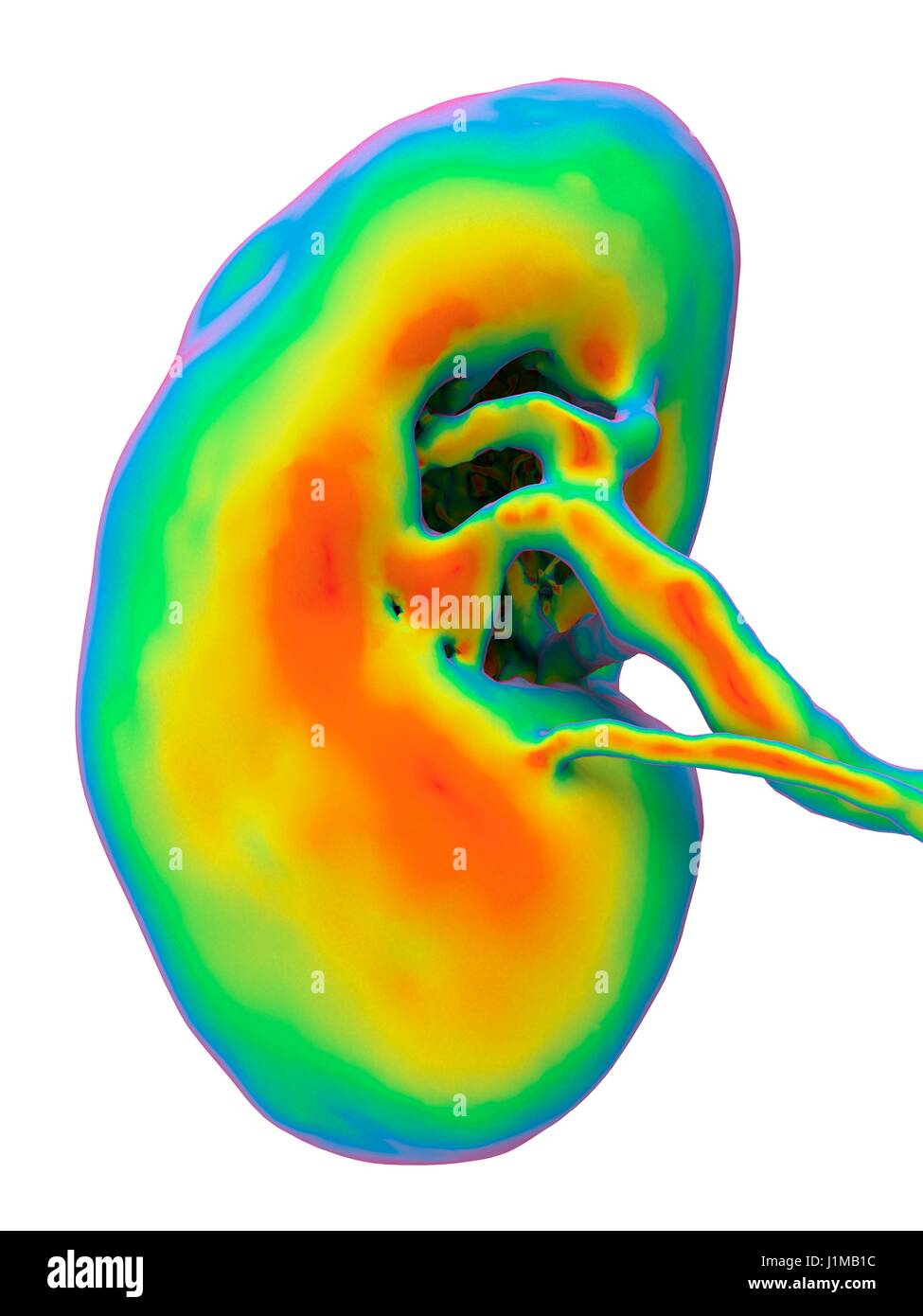 Niere, CT-Scan. Falsche Farbe 3-d Computertomographie (CT) Scan einer Niere in Frontalansicht. Stockfoto