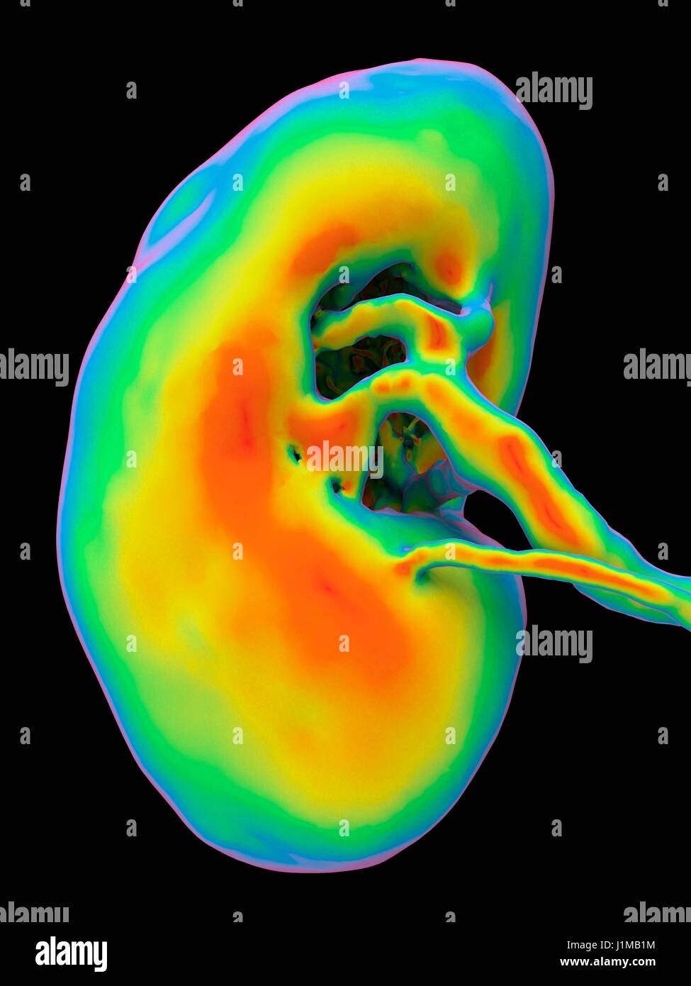 Niere, CT-Scan. Falsche Farbe 3-d Computertomographie (CT) Scan einer Niere in Frontalansicht. Stockfoto