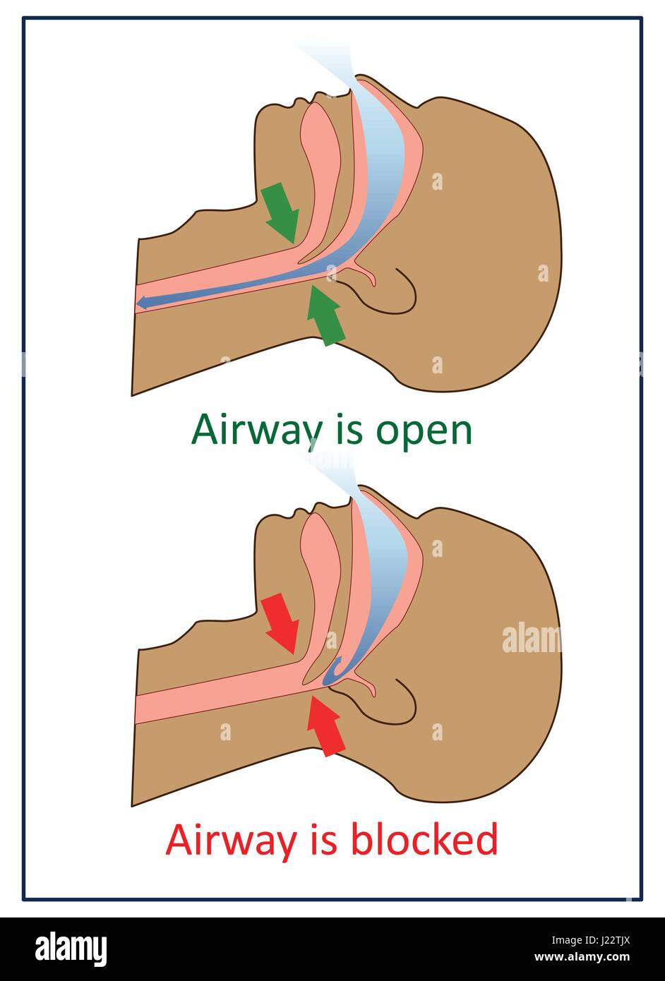 VektorIllustration der normalen Atmung und ApnoeSymptome Stock