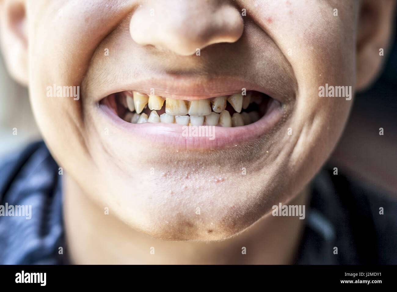 Ein Junge seine schmutzige Zähne zeigen. Stockfoto