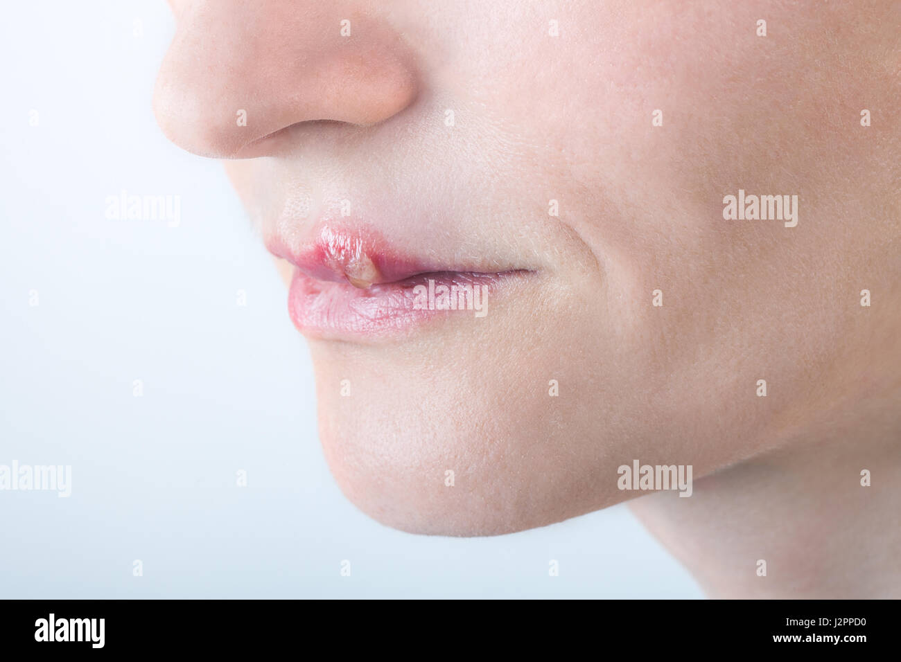 schöne Frau mit Lippen-Virus infiziert Herpes isoliert auf weißem Hintergrund Stockfoto