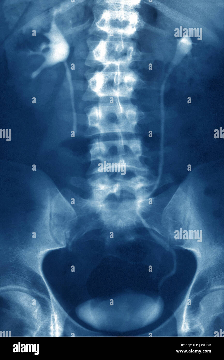 NIEREN-KOLIK, X-RAY Stockfoto