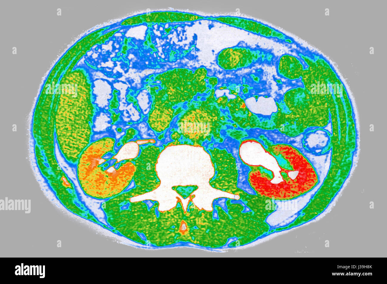 NIEREN-KOLIK, SCAN Stockfoto