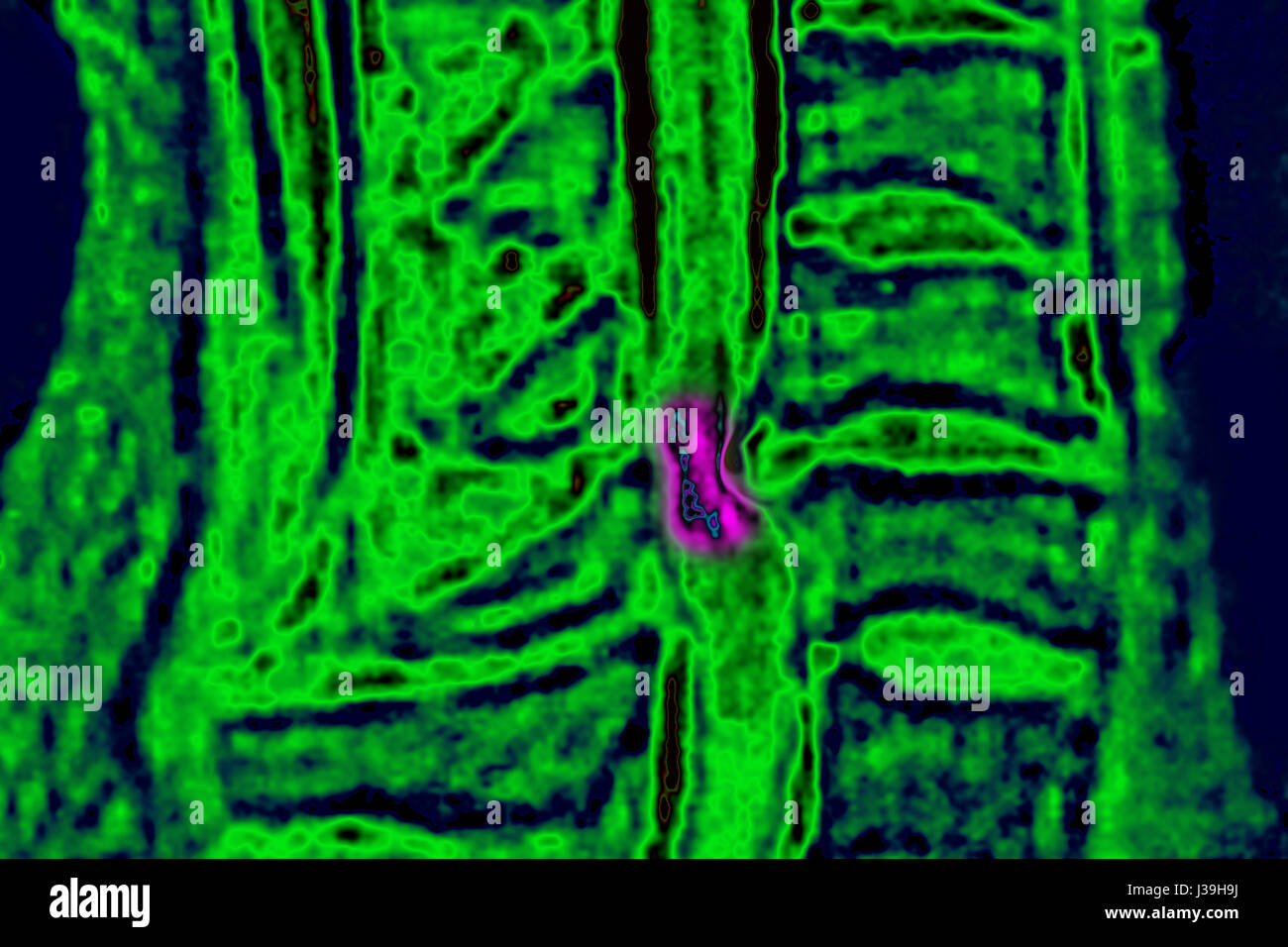 BANDSCHEIBENVORFALL, MRT Stockfoto