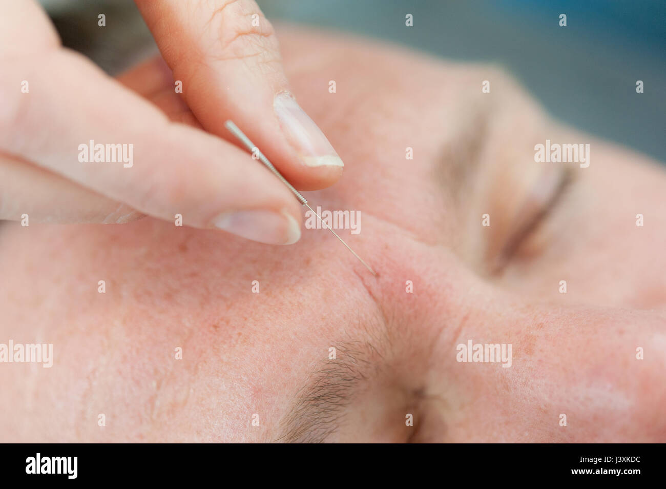 Acupuncturist einfügen Akupunktur Nadeln in die Haut des Patienten Stockfoto