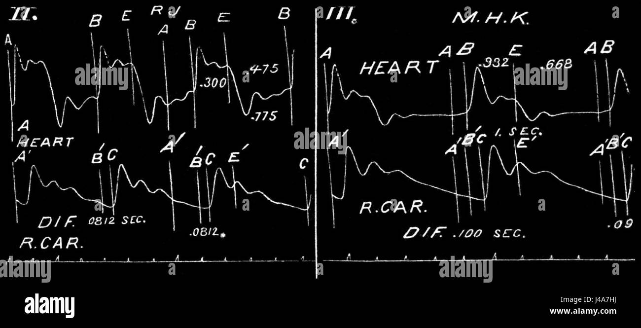 PSM V25 D204 Sphygmograph produziert zusammengesetzte Ergebnisse Diagramm Stockfoto