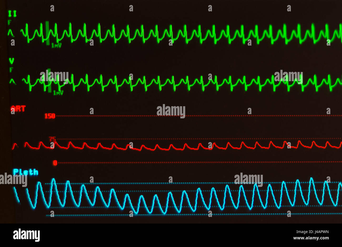 Schwarzer Monitor mit AVNRT/ventrikulären Knoten reentrant Tachykardie (grüne Linien), arteriellen Blutdruck (rot) und Sauerstoffsättigung (blau) Stockfoto