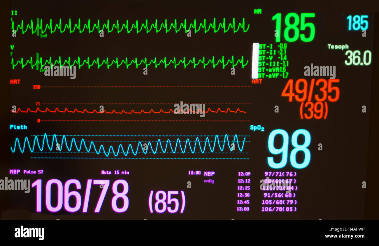 Schwarzer Monitor mit ventrikulären Knoten reentrant Tachykardie /AVNRT (grüne Linien), arteriellen Blutdruck (rot) und der Sauerstoffsättigung (blau) Stockfoto