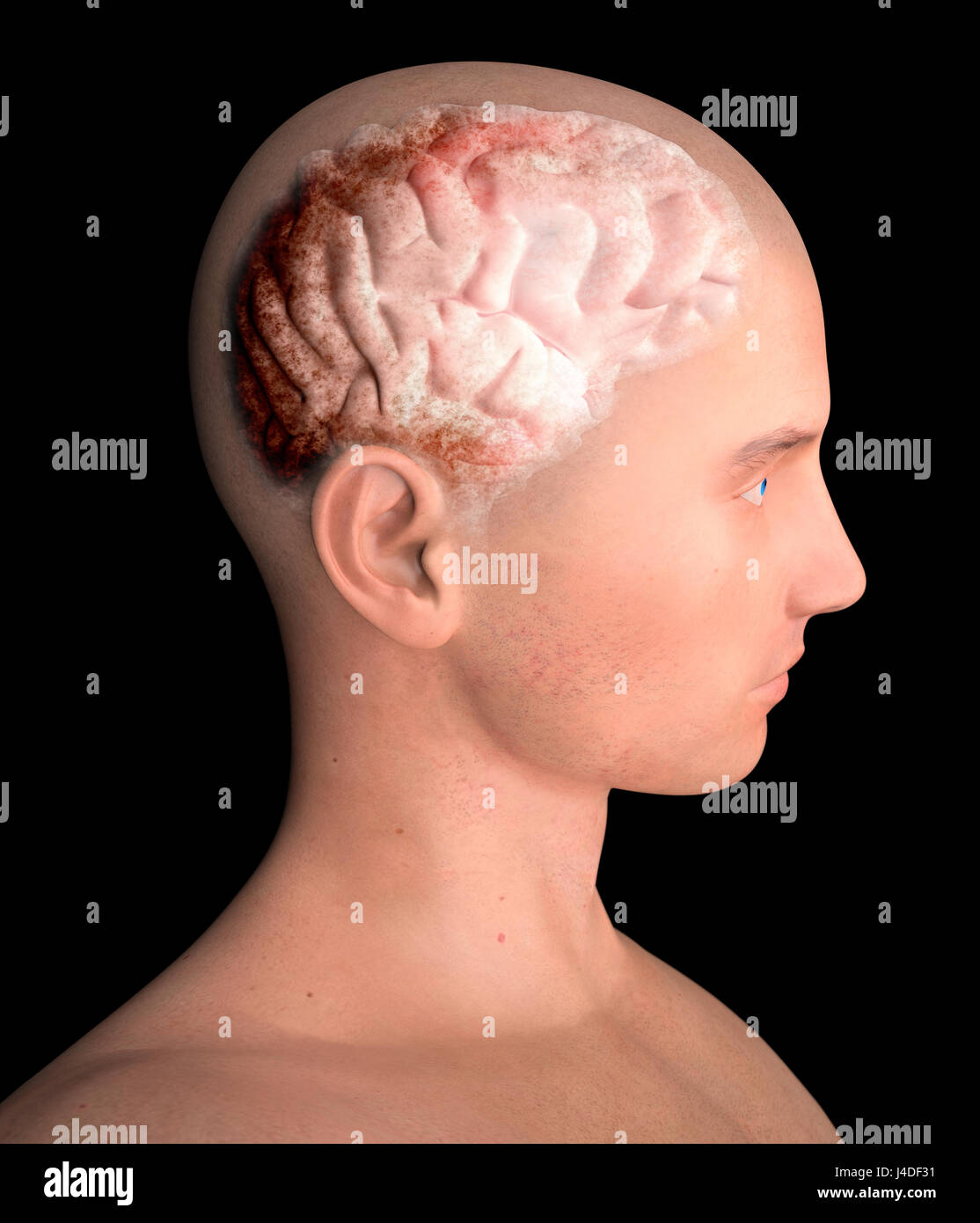 Gehirn, degenerativen Erkrankungen, Parkinson, menschlicher Körper, Gesicht. 3D-Rendering Stockfoto