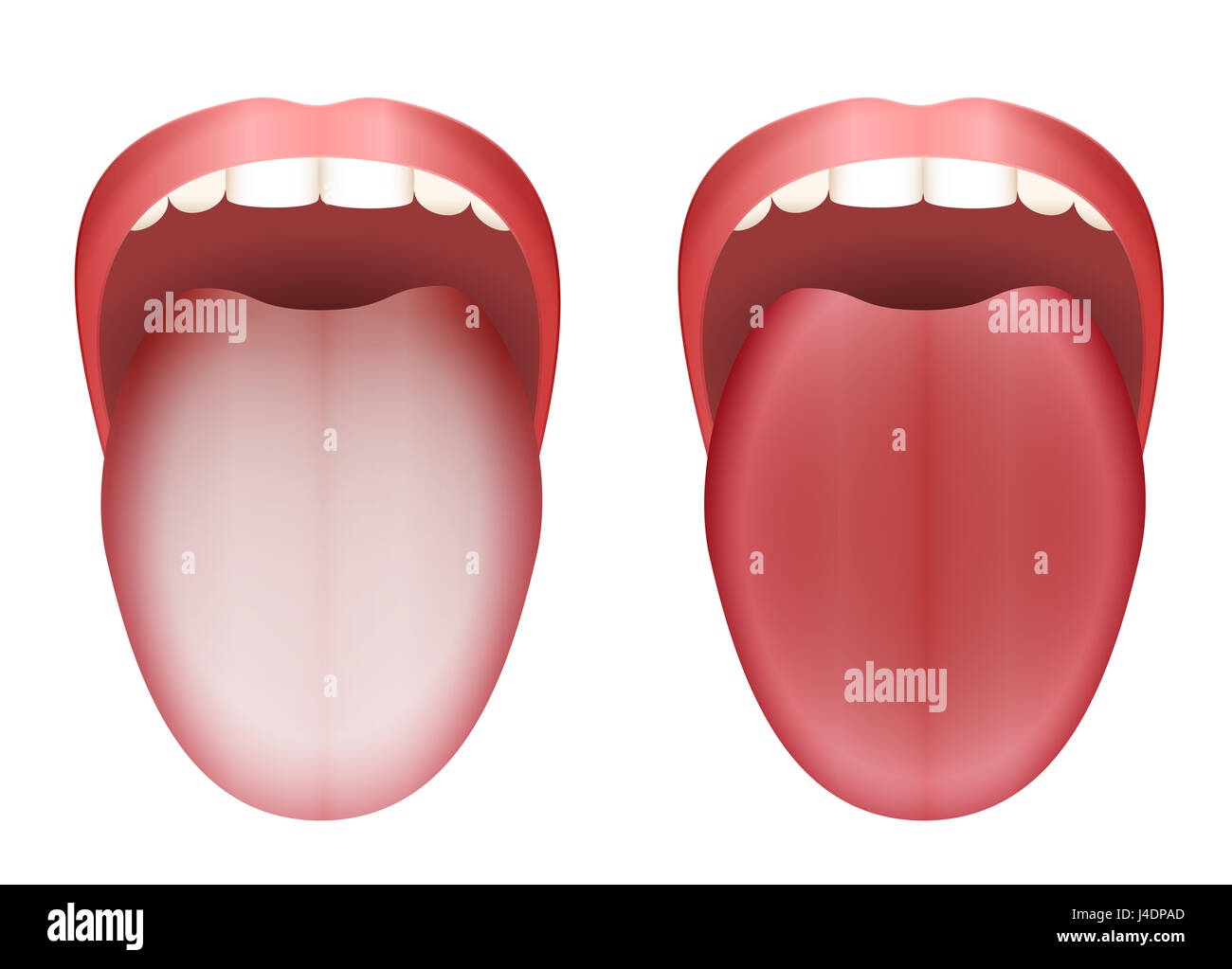 Beschichtete weiße Zunge und saubere, gesunde Zunge durch Vergleich - Abbildung auf weißem Hintergrund. Stockfoto