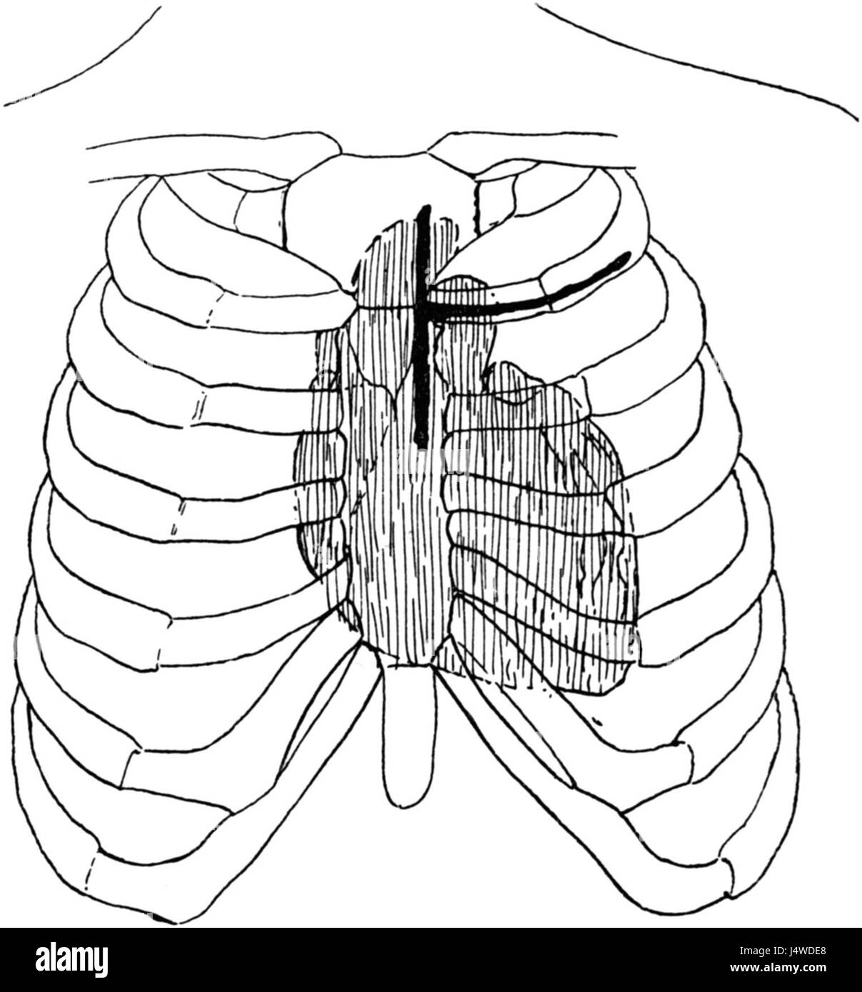 Trendelenburg OP Lungenembolie Titel Stockfoto