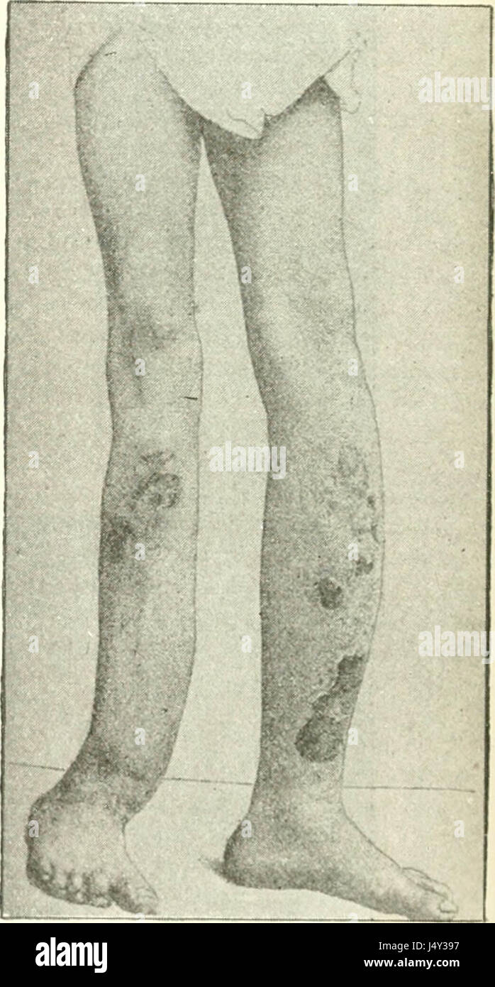 "Hermaphroditismus Beim Menschen" (1908 Stockfotografie Alamy