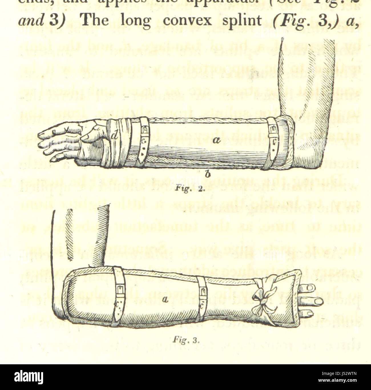 Dieses Bild von Seite 228 von *praktische Bemerkungen zur Art und Behandlung von Frakturen des Rumpfes und der Extremitäten* bietet eine medizinische Illustration oder ein Diagramm, in dem Frakturen diskutiert werden. Dieser Text war für die Entwicklung des medizinischen Wissens im 19. Jahrhundert über die Behandlung von Verletzungen und das anatomische Verständnis von Bedeutung. Stockfoto