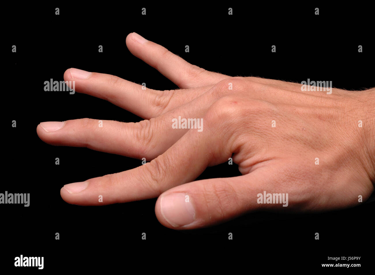 Ehlers-Danlos-Syndrom Stockfoto