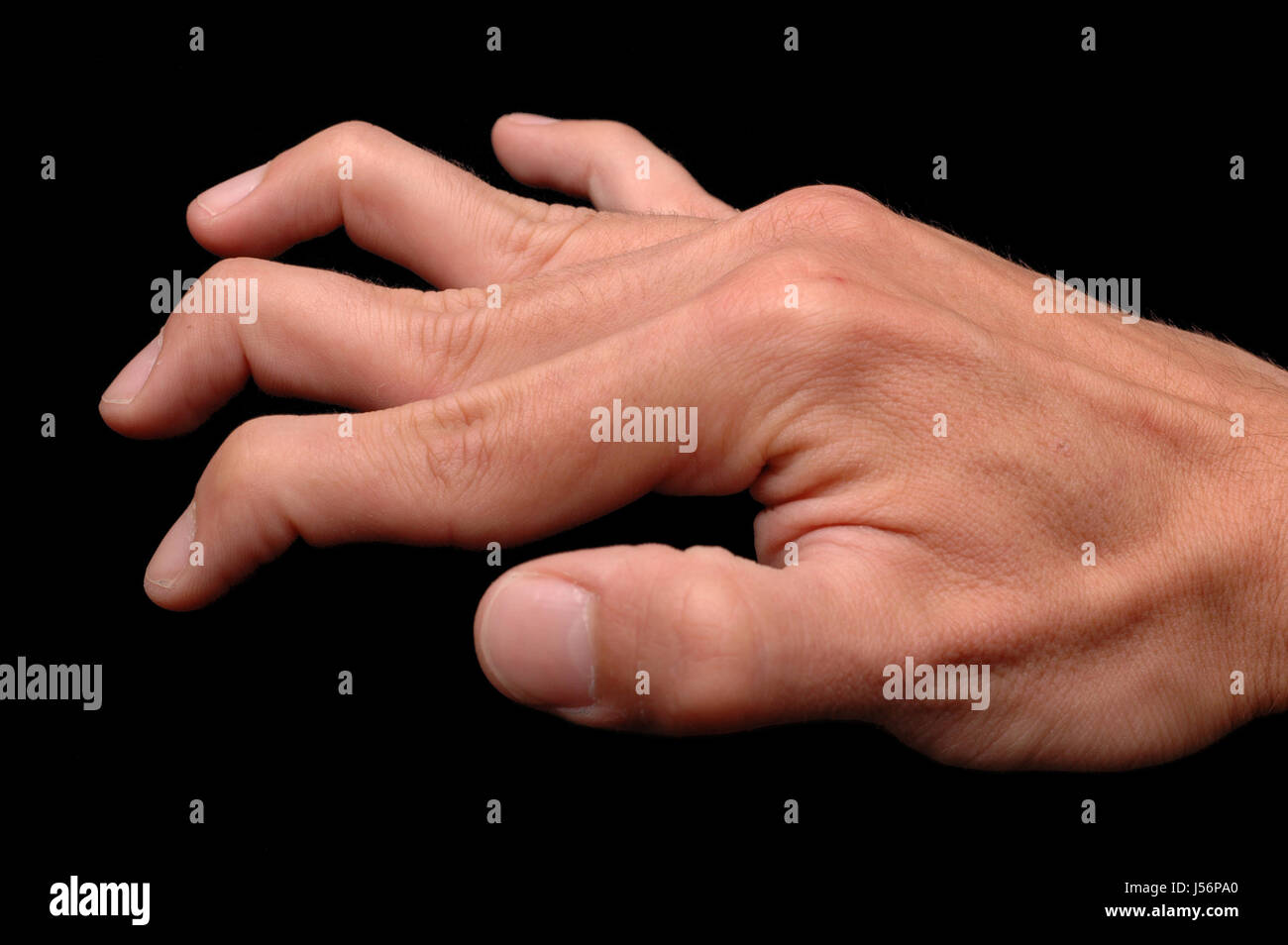 Ehlers-Danlos-Syndrom Stockfoto