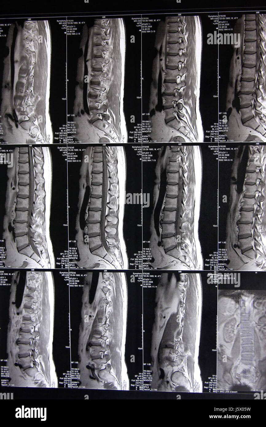Wirbelsäule bruchleidende Scheibe Bandscheiben Lendenwirbel Untersuchung Stockfoto