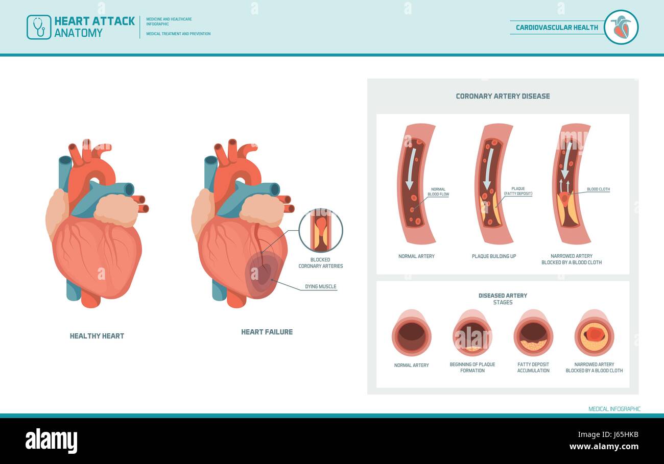 Herzinfarkt und Arteriosklerose medizinische Illustration: gesund und beschädigte Herz, Blutgefäße Abschnitt mit fetthaltige Ablagerung Akkumulation Stock Vektor