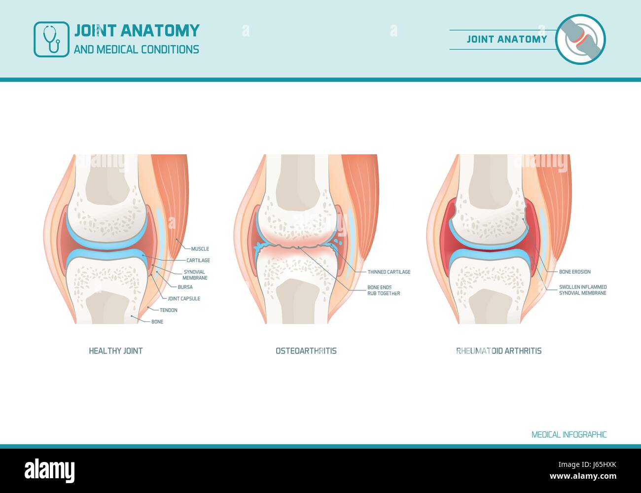 Gemeinsame Anatomie, Arthrose und rheumatoider Arthritis Infografik mit anatomischen Abbildungen Stock Vektor