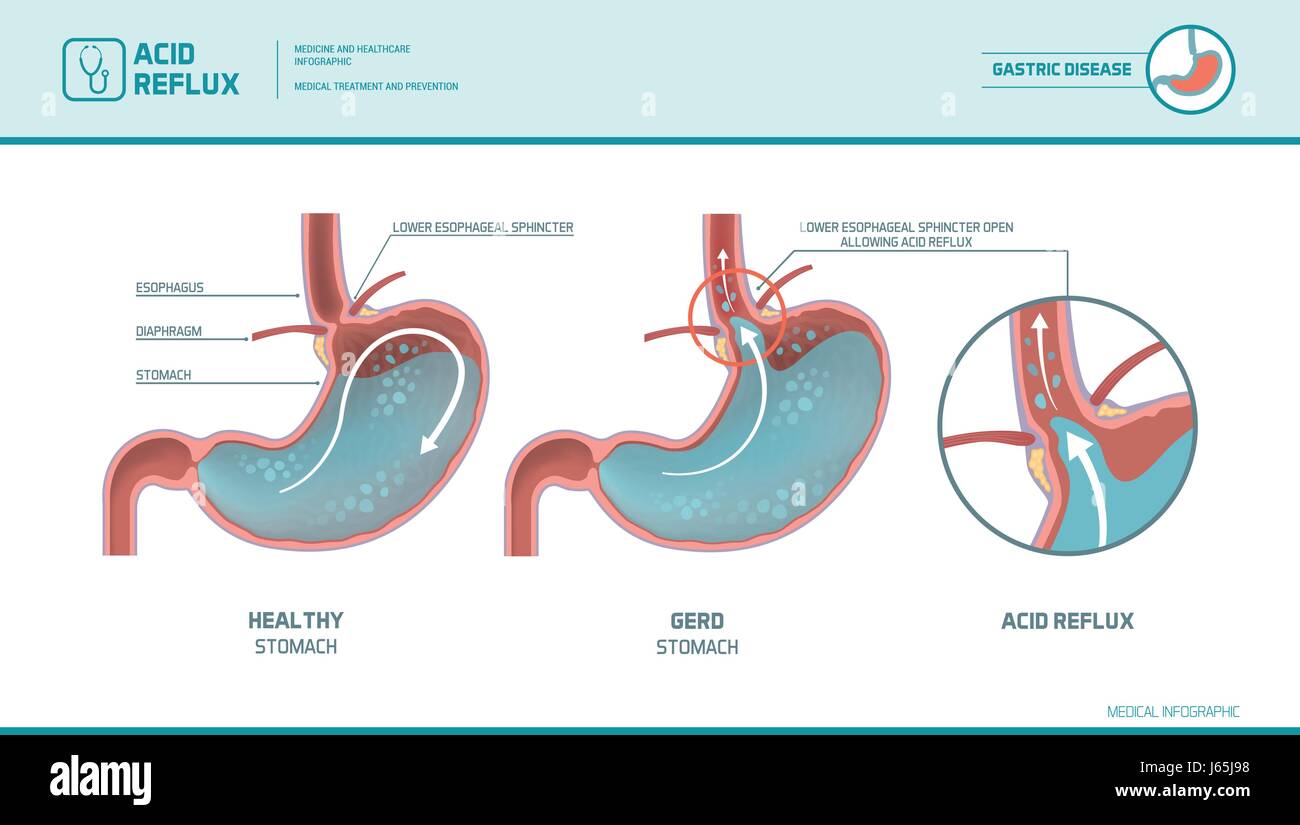 Saurem Reflux, Sodbrennen und Gerd Infografik mit medizinische Illustration: Magen Säure Aufstieg in die Speiseröhre verursacht Sodbrennen Symptome Stock Vektor