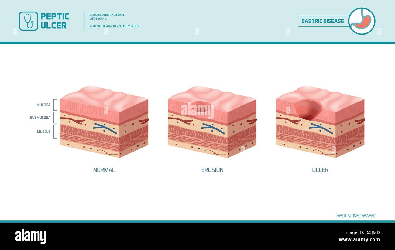 Magen, Erosion und Magengeschwür Phasen Infografik: Magen-Futter und Schleimhaut Kreuz Abschnitt Diagramm, medizinische Illustration Stock Vektor