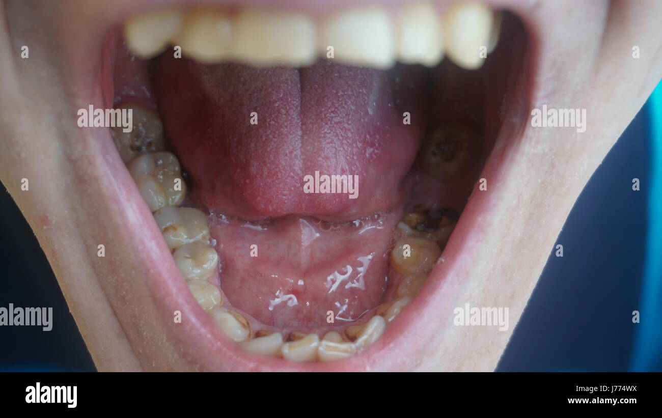 Zähne mit 20 schlechte Trotz Vorsorge