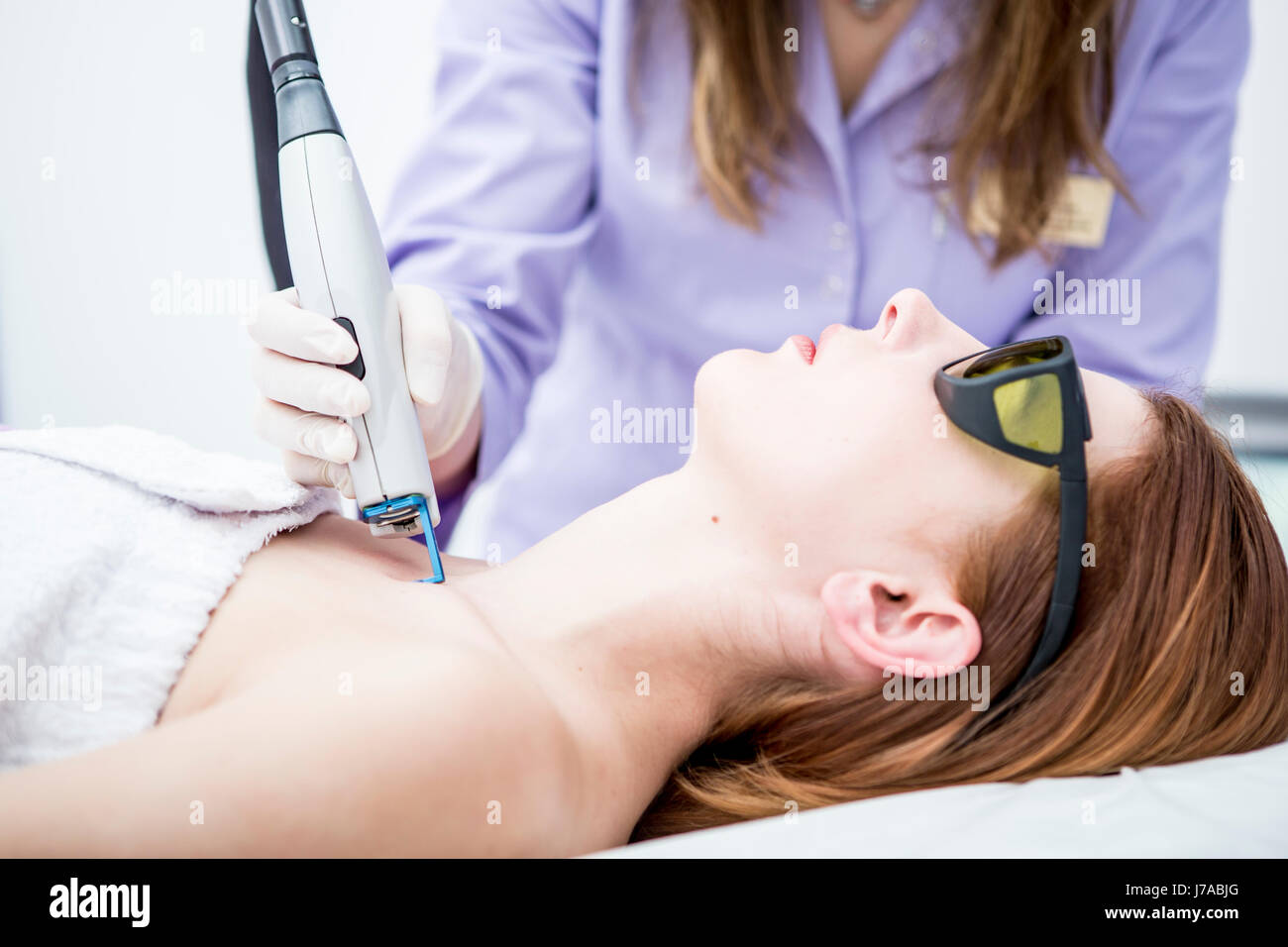 Ästhetische Chirurgie, vaskulären Laserbehandlung Stockfoto