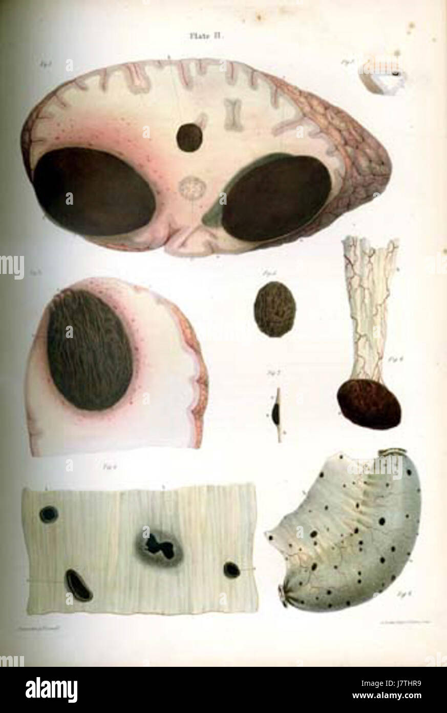 Das Carswell Melanoma 2wf bezieht sich auf eine Studie oder Referenz im Zusammenhang mit Melanom, einer Art von Hautkrebs, benannt nach einem Forscher oder einer Institution, die an seiner Entdeckung oder Studie beteiligt ist. Melanom ist eine schwere Form von Hautkrebs, der sich auf andere Körperteile ausbreiten kann, wenn er nicht frühzeitig erkannt und behandelt wird. Stockfoto