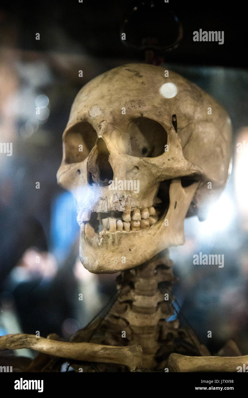 Menschlicher Schädel (Old Operating Theatre Museum und Kraut Garret, London, UK) Stockfoto