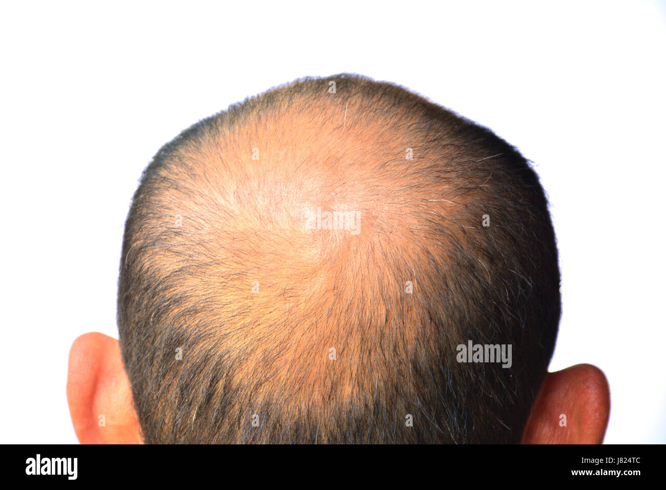 Kopf des Menschen verlieren die Haare, unbehaart auf seinem Kopf für ältere Menschen Stockfoto