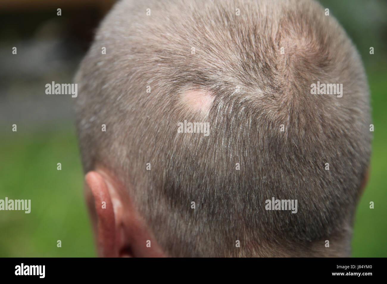 Mann mit Haarausfall Stockfoto