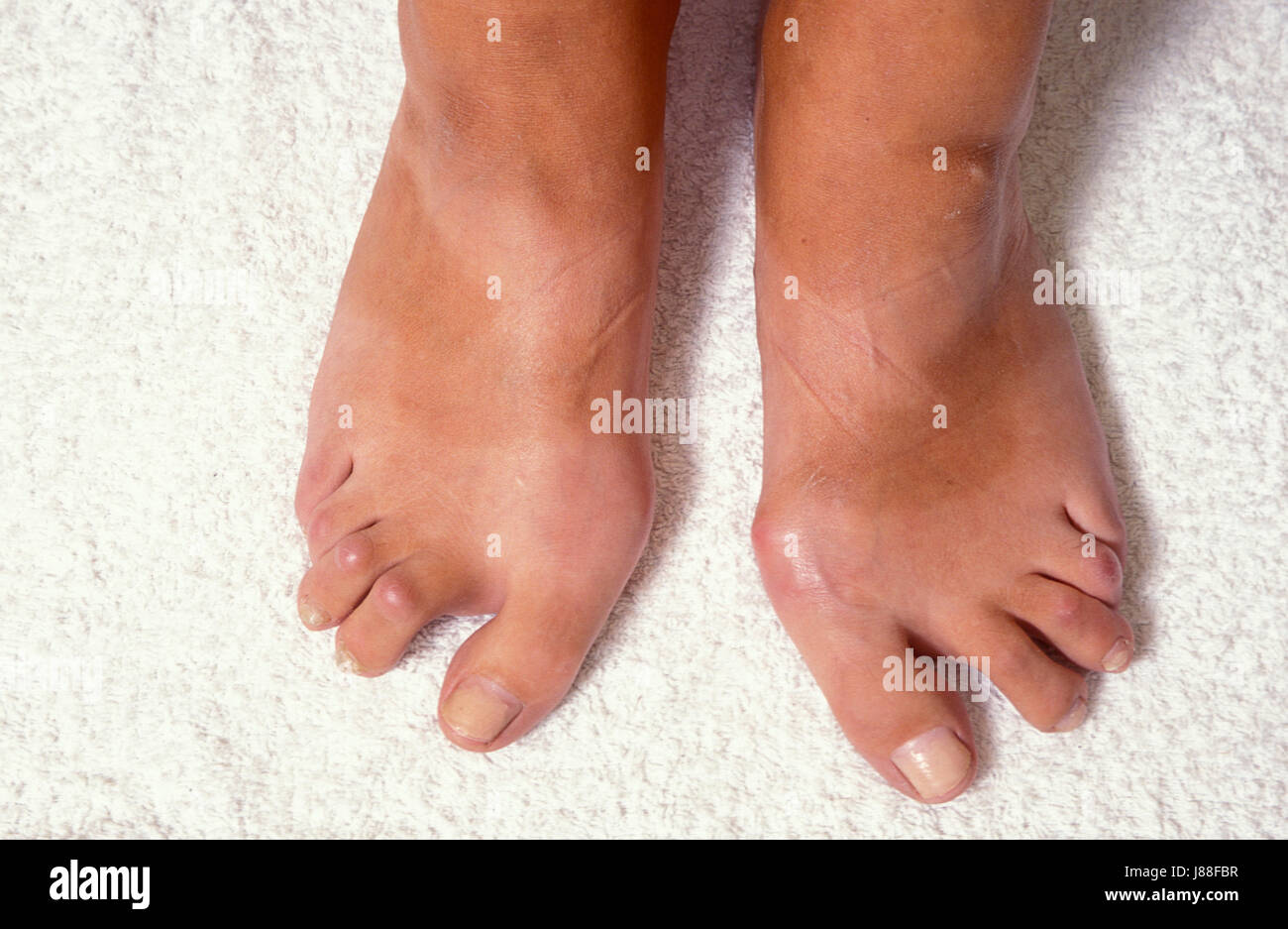 Füße der erwachsenen Frau verformt durch Osteo-arthritis Stockfoto