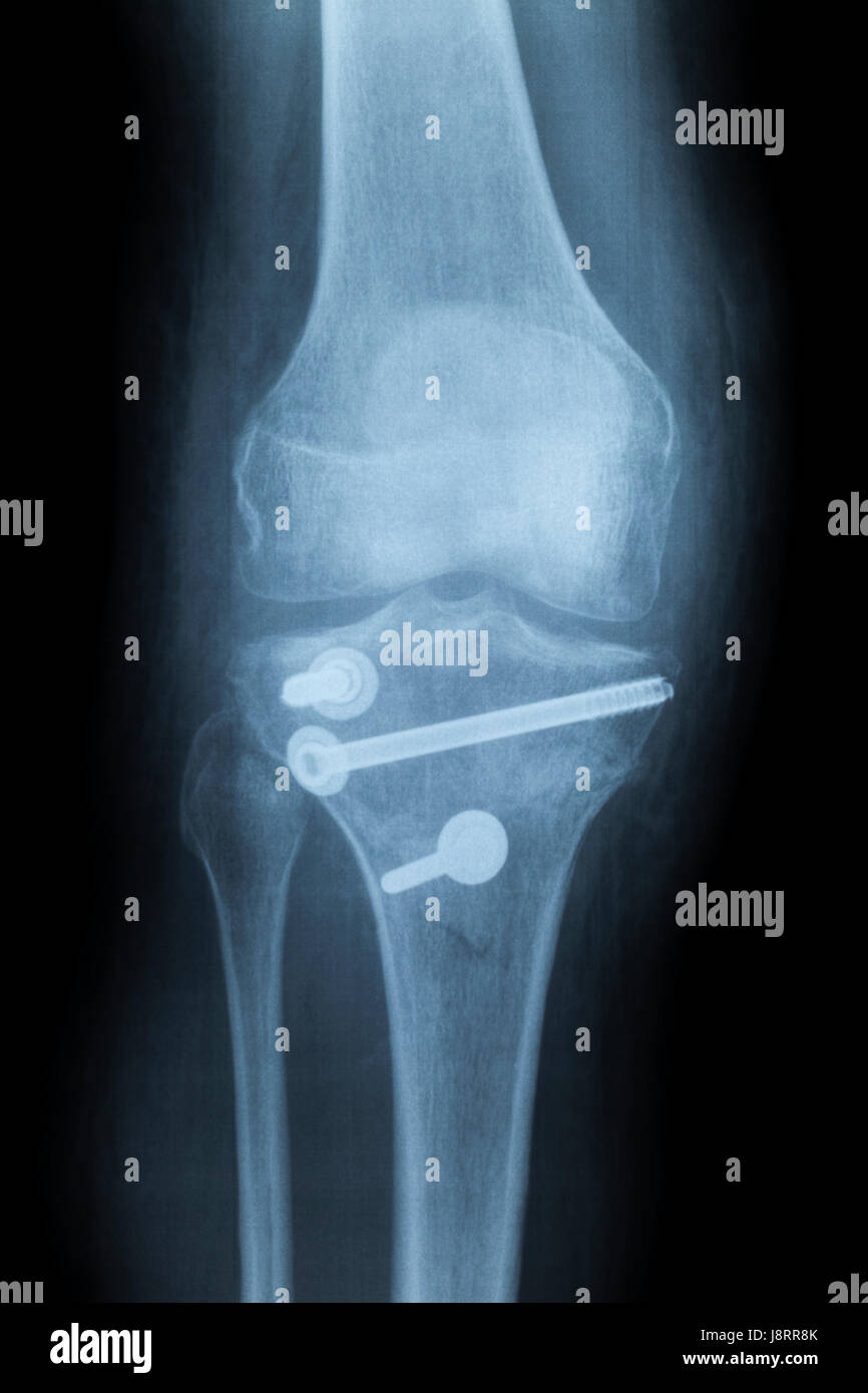 menschlichen Knie anterior-Posterior, Röntgenbild nach Reduzierung von sc Stockfoto