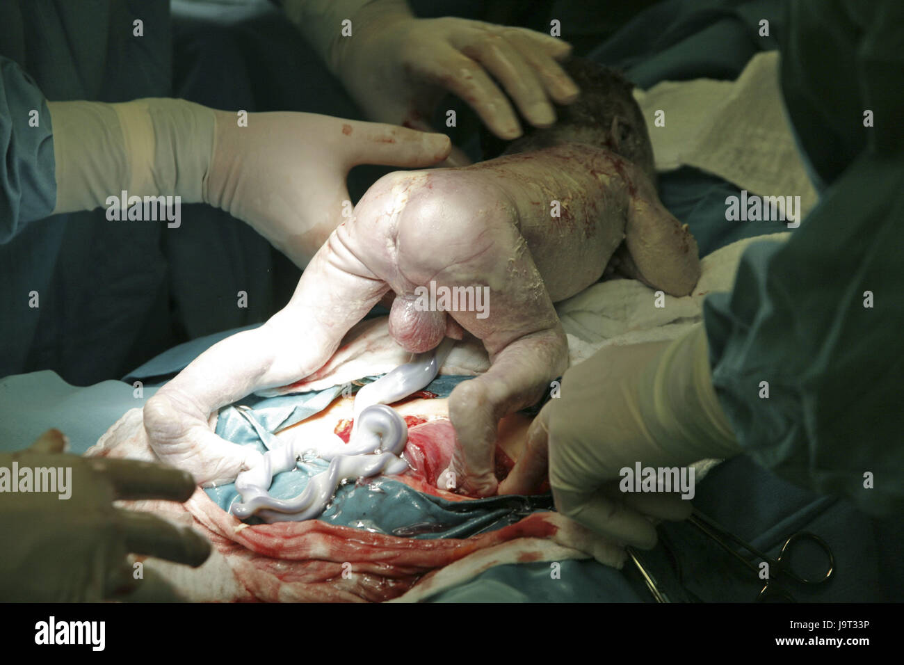 Halle Kreis, Operationsteam, Geburt, Kaiserschnitt Abschnitt, Stockfoto