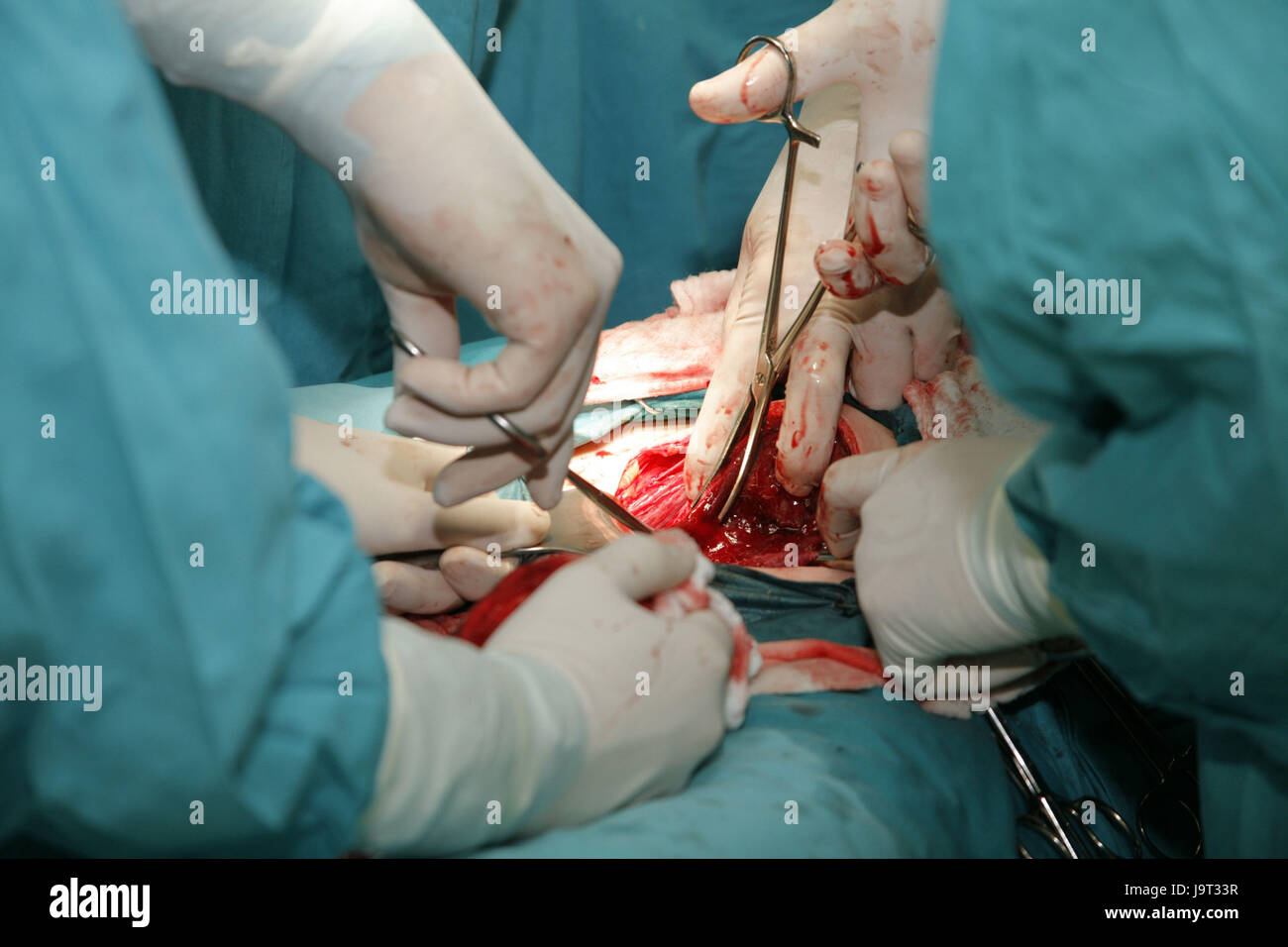 Halle Kreis, Operationsteam, Geburt, Kaiserschnitt Abschnitt, Stockfoto