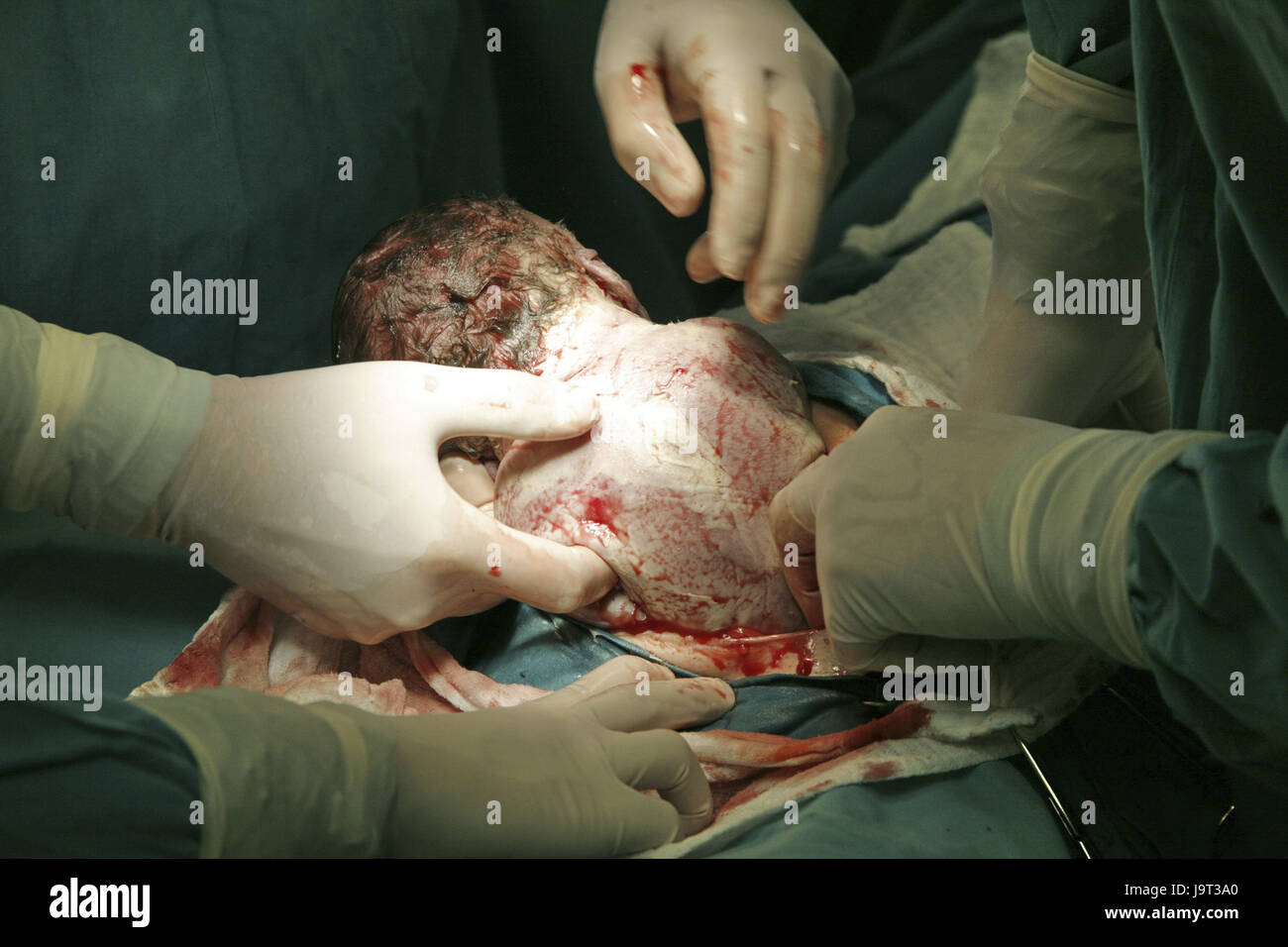 Halle Kreis, Operationsteam, Geburt, Kaiserschnitt Abschnitt, Stockfoto