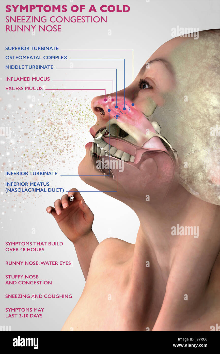 Symptome von einer kalten, menschliche Anatomie, 3D-Schnitt eines Gesichts, Mädchen mit kalten. Pollenallergie. 3D-Rendering Stockfoto