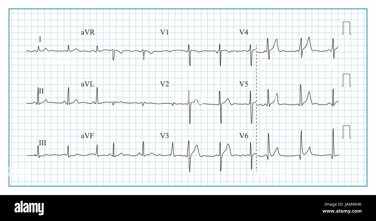 Herz Ekg Diagramm Vektor Darstellung Der Wellenform In Aufgegebenen Ekg Diagramm Rhythmus Ischamie Herzinfarkt Herzschlag Stock Vektorgrafik Alamy