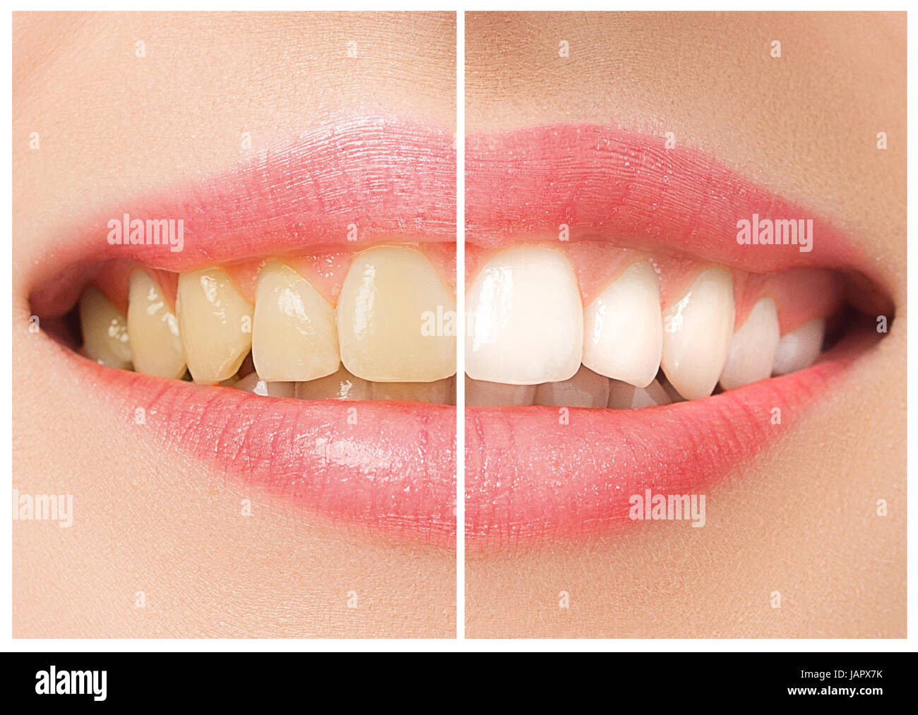 Die weibliche Zähne vor und nach der Aufhellung. Stockfoto