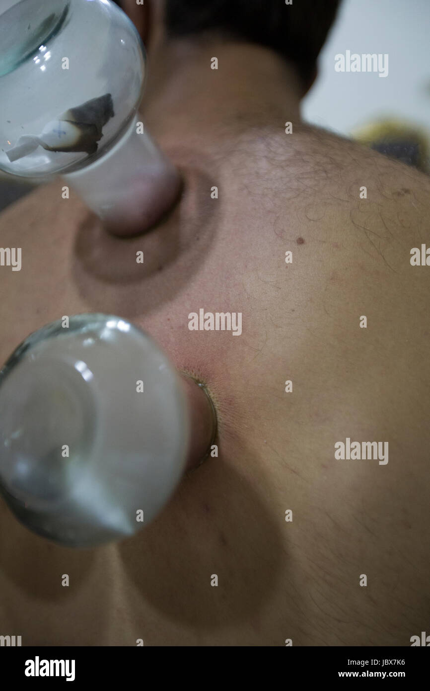 Details eines Mannes immer getan mit einem Therapeuten Schröpfen Stockfoto