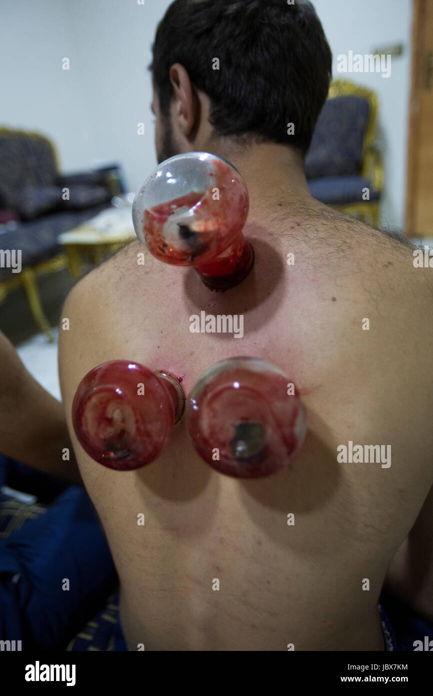 Details eines Mannes immer getan mit einem Therapeuten Schröpfen Stockfoto