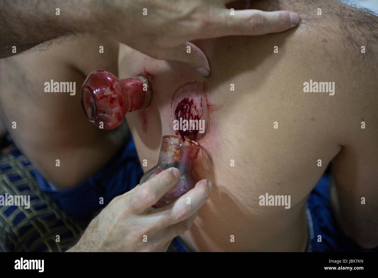 Details eines Mannes immer getan mit einem Therapeuten Schröpfen Stockfoto