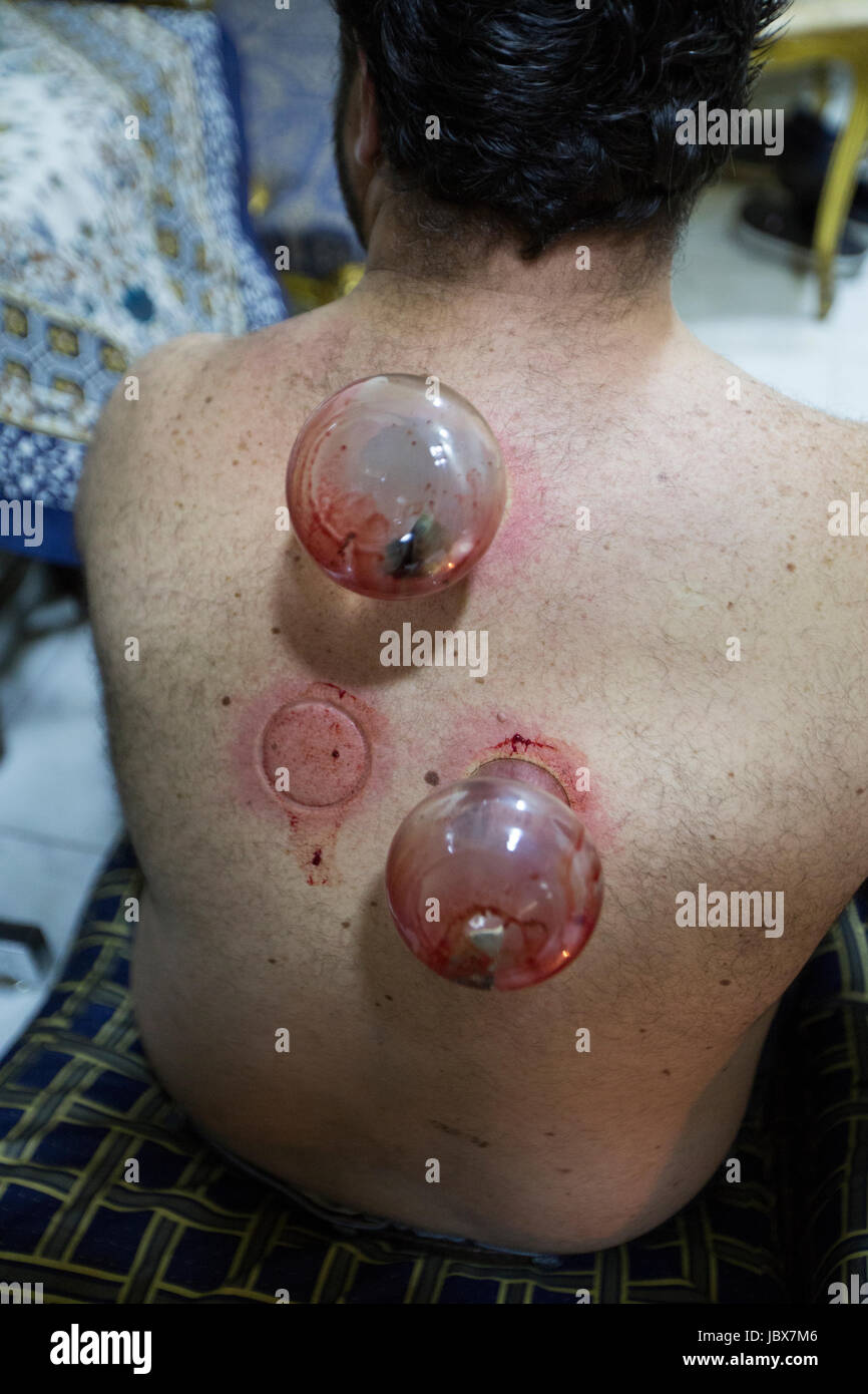 Details eines Mannes immer getan mit einem Therapeuten Schröpfen Stockfoto