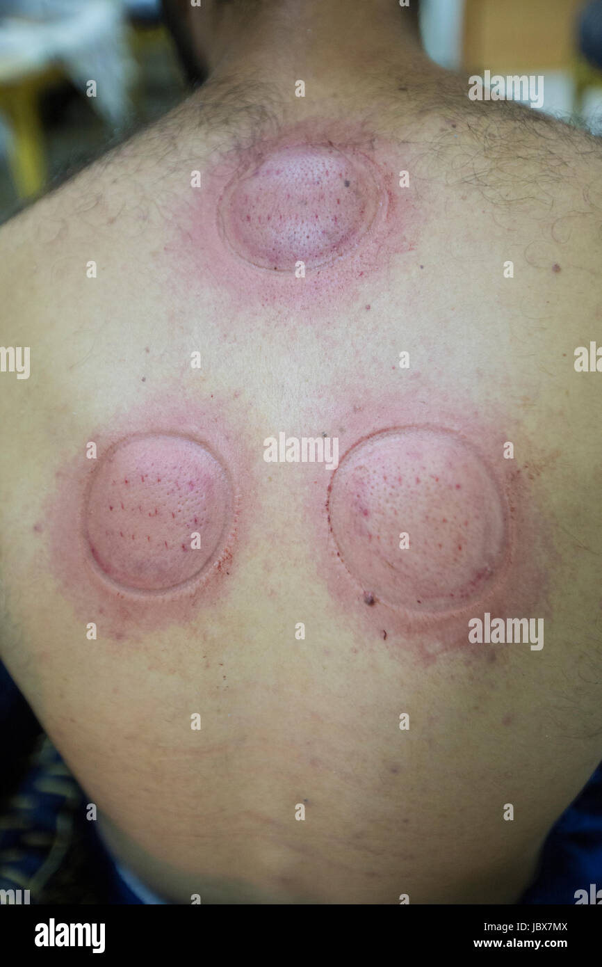 Details eines Mannes immer getan mit einem Therapeuten Schröpfen Stockfoto